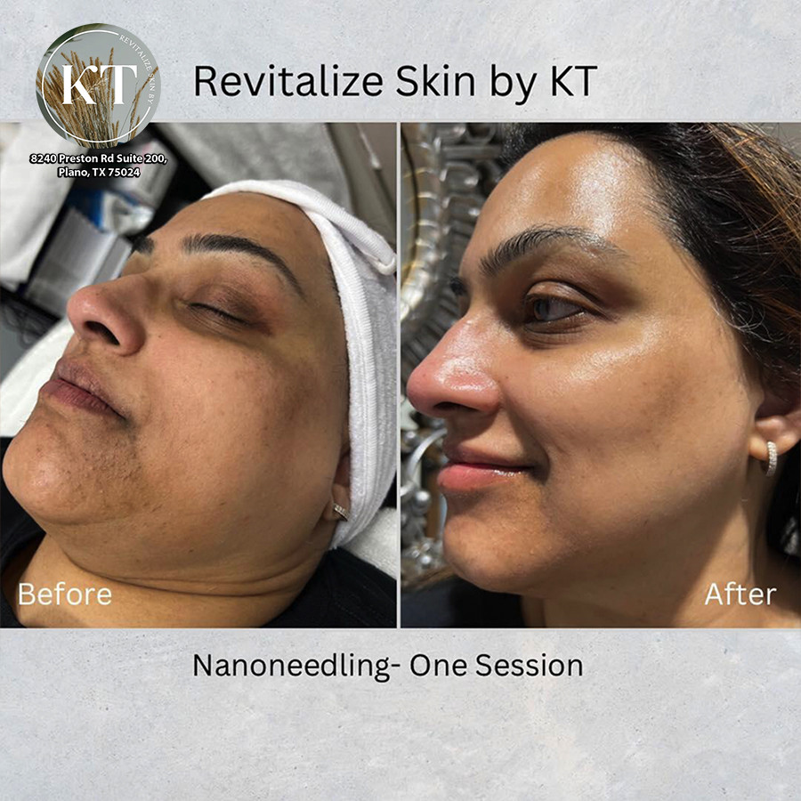 Benefits of Facials and Skin Treatments at REVITALIZE SKIN BY KT - Best day spa Plano, TX 75024 - Hydrafacial 75024