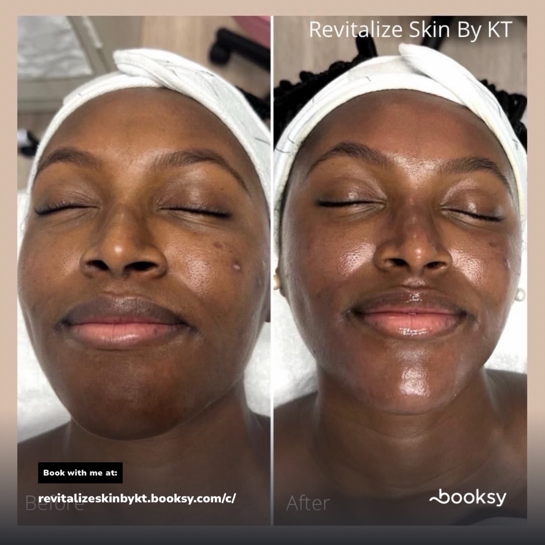 SIGNATURE GLOW SYNDEO HYDRAFACIAL | REVITALIZE SKIN BY KT in Plano, TX 75024 | Best Day Spa and Hydrafacial