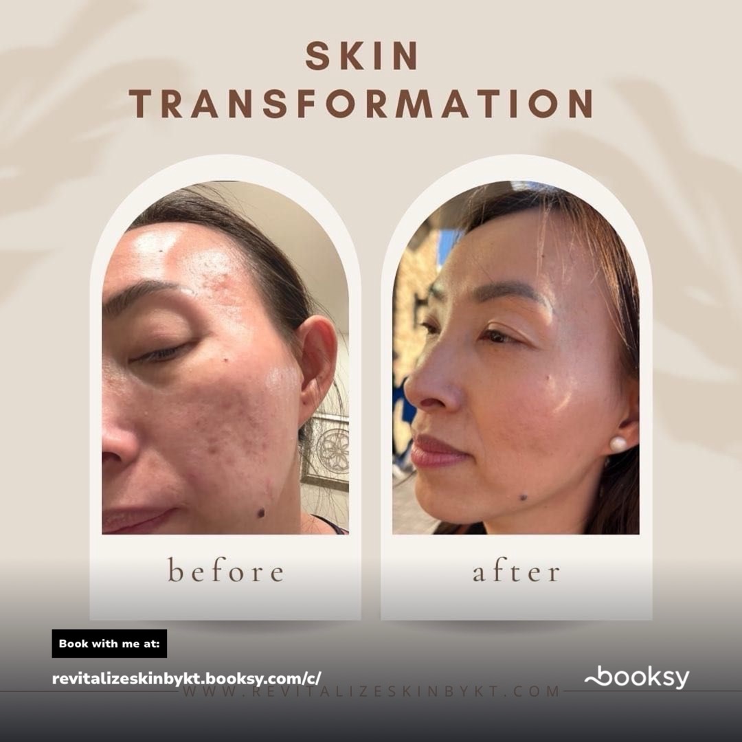 ACNE DETOX & CLARIFYING SYNDEO HYDRAFACIAL | REVITALIZE SKIN BY KT in Plano, TX 75024 | Best Day Spa and Hydrafacial