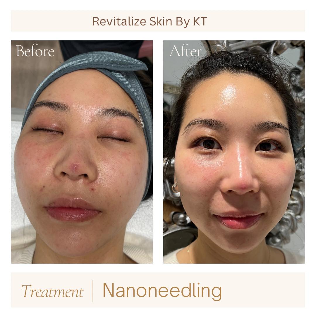 NANONEEDLING (Micro- Exfoliation) | REVITALIZE SKIN BY KT in Plano, TX 75024 | Best Day Spa and Hydrafacial