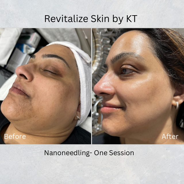 HYDRAFACIAL + NANONEEDLING: DEEP SKIN RENEWAL | REVITALIZE SKIN BY KT in Plano, TX 75024 | Best Day Spa and Hydrafacial