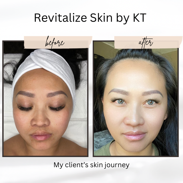 ULTIMATE ANTI-AGING REJUVENATION HYDRAFACIAL | REVITALIZE SKIN BY KT in Plano, TX 75024 | Best Day Spa and Hydrafacial