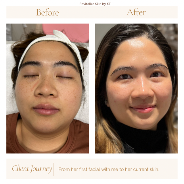 BRIDAL RADIANCE package-5 HYDRAFACIAL | REVITALIZE SKIN BY KT in Plano, TX 75024 | Best Day Spa and Hydrafacial